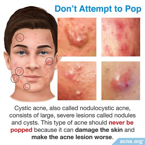 Source: LINK. . Cystic acne on cheeks popping videos